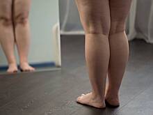 Эндокринолог рассказала, можно ли полностью избавиться от целлюлита