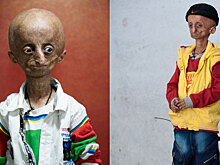 Болезнь превратила 15-летнего индийца в старика