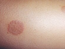 Ученые рассказали, почему на теле появляются красные пятнышки