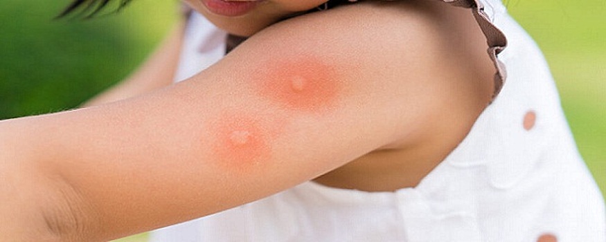 Иммунолог Быков предупредил, что укус комара может вызвать сильную аллергическую реакцию у детей с мастоцитозом