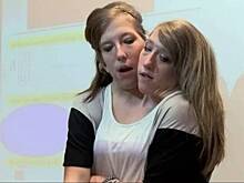 Одно тело на двоих: пять историй самых известных сиамских близнецов